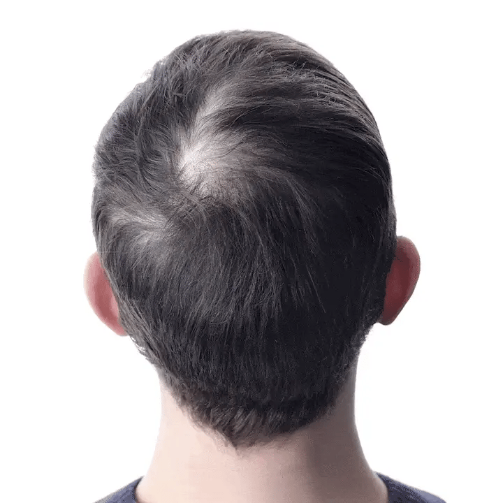 Resultados después de 90 días con HairGrow