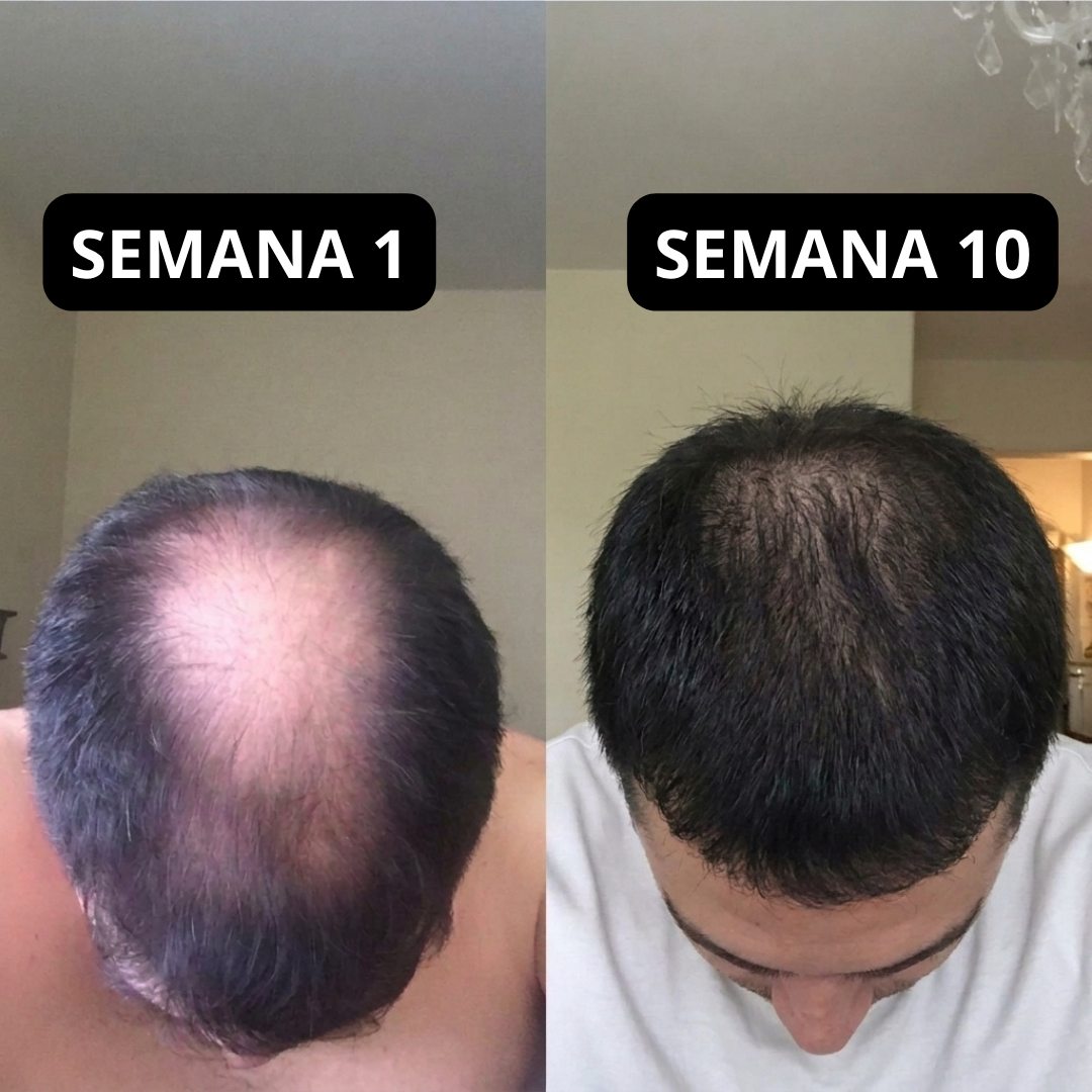 FolixDerm - Sistema de recuperación Capilar